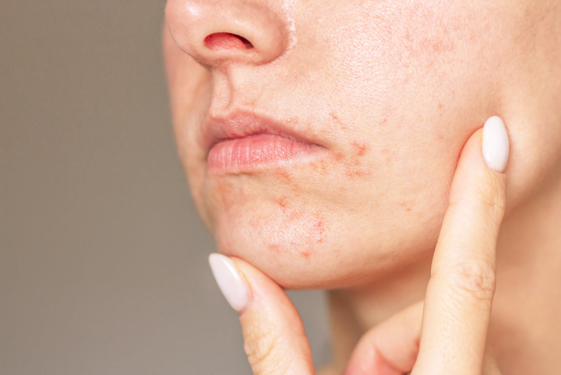Perioral Dermatitis: A Sensible Guide