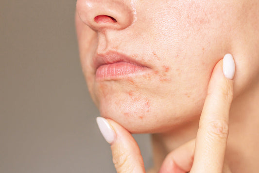 Perioral Dermatitis: A Sensible Guide