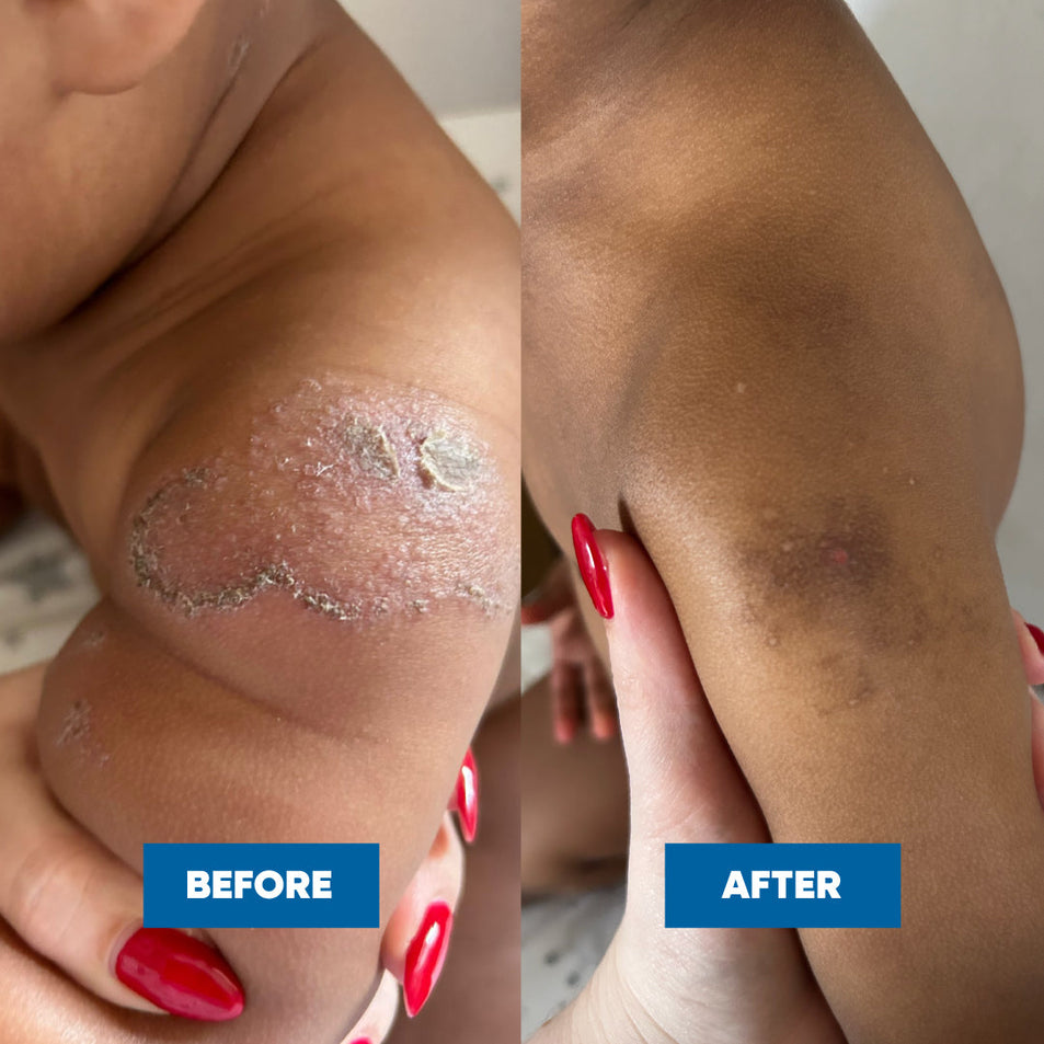 Before and after comparison of a childs arm with visible improvements after using the MooGoo Sensitive Skin Balm and Soothing MSM Moisturiser on his discoid eczema.